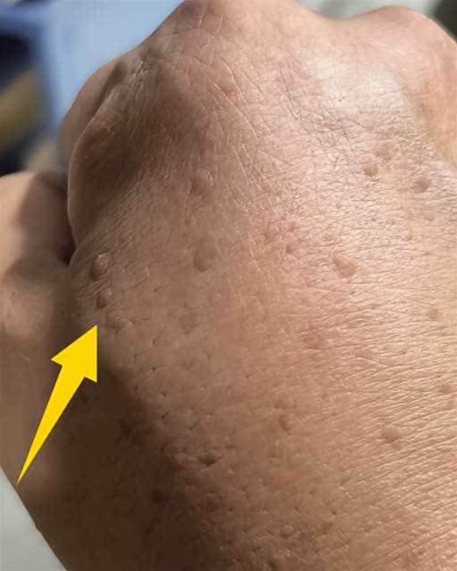 40歲手背驚現棕點！好友一句「老人斑」害他失眠…網友秒回「1句話」秒解心結