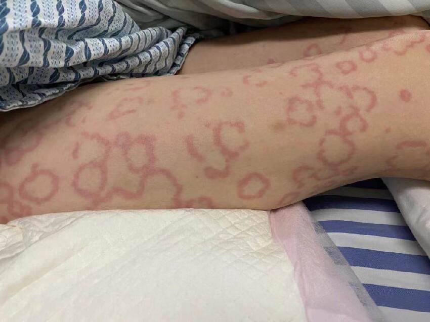 一覺醒來腿上長滿「梅花印」 女子壞緊急就醫，醫生揪出「一元兇」竟是她床頭常見物