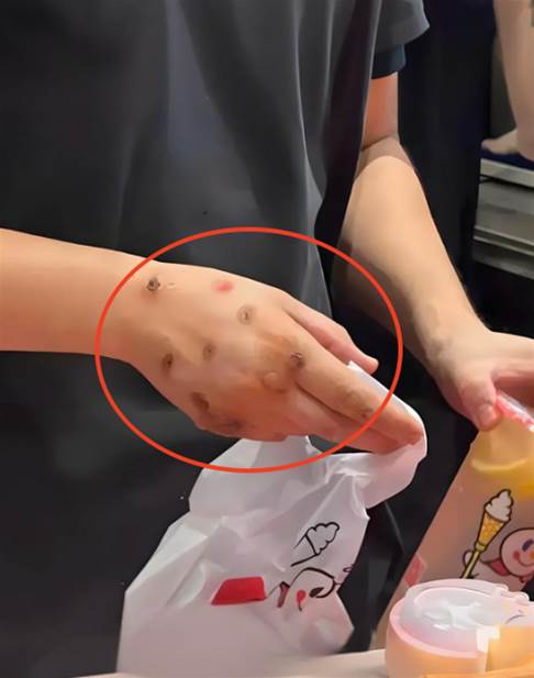買奶茶驚見店員手背佈滿「黑色圓疤」！網友嚇瘋：快丟掉別喝