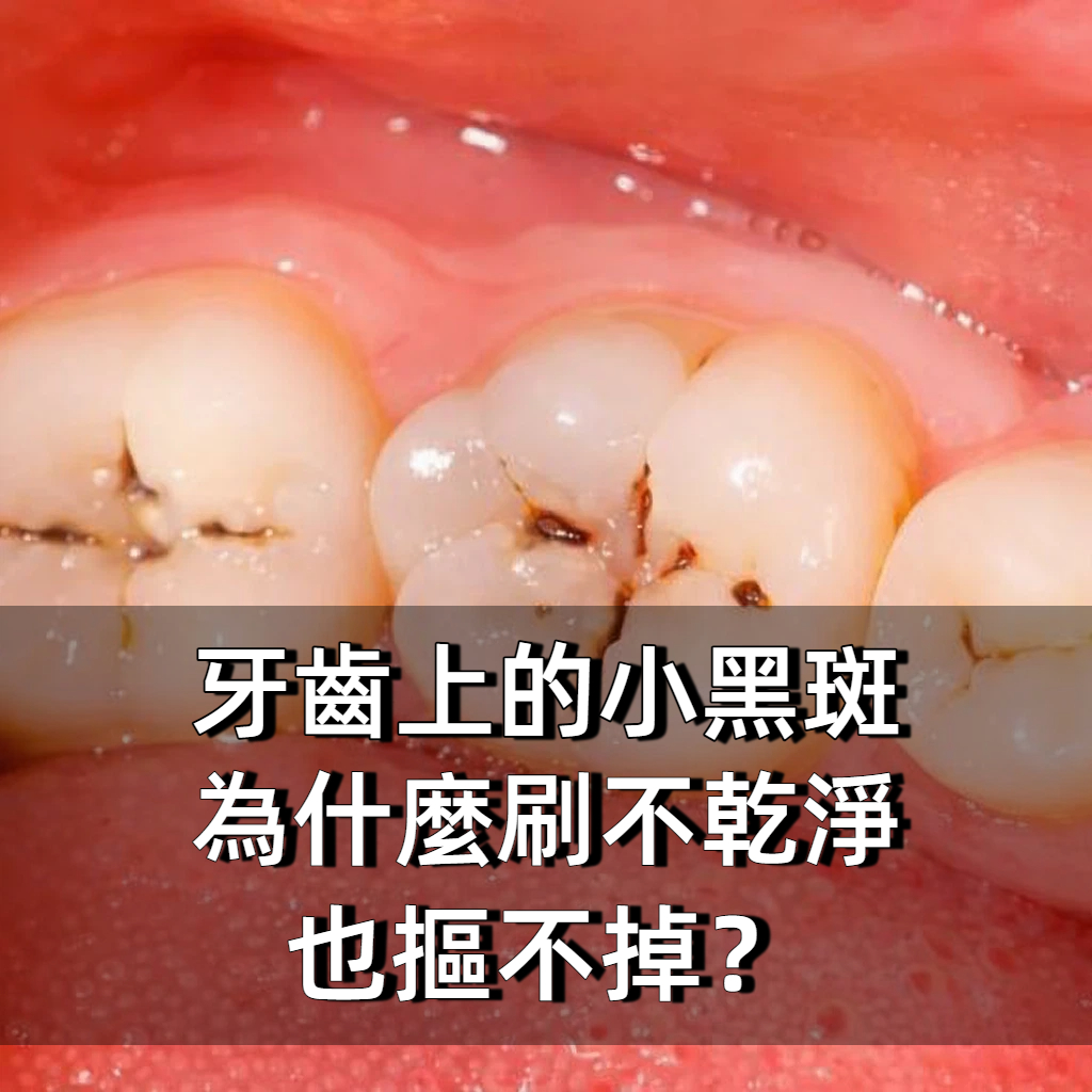 牙齒上的小黑斑「為什麼刷不乾淨也摳不掉」?牙醫告訴你真相!