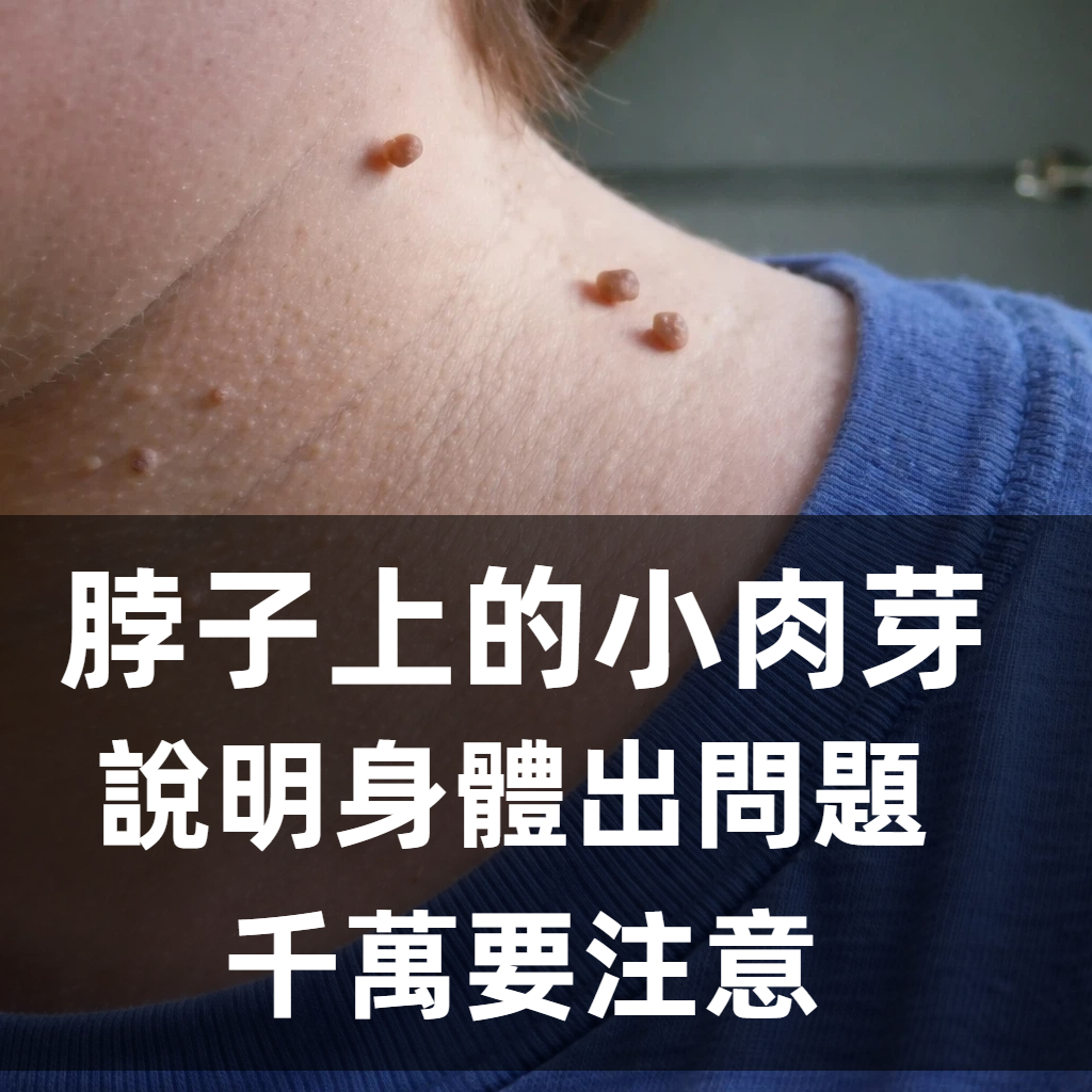 脖子上的小肉芽，說明身體出了問題，千萬要注意！