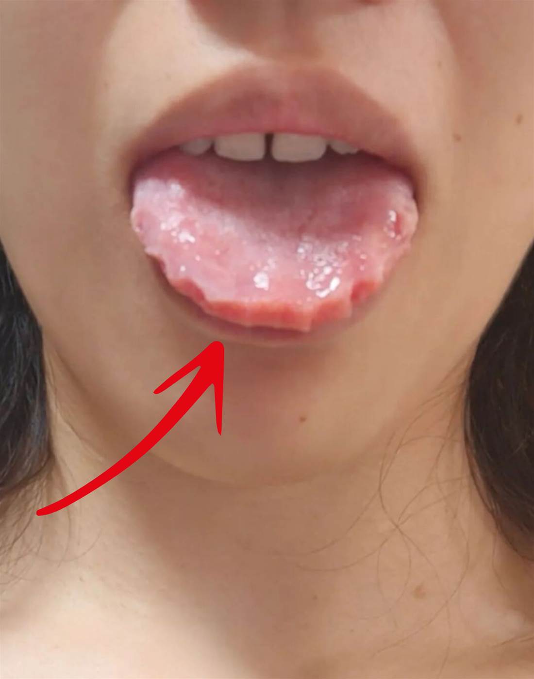 女子PO出「鋸齒舌頭」求助！網友瘋狂@她快就醫，檢查結果全家崩潰：再晚一周就危險了！