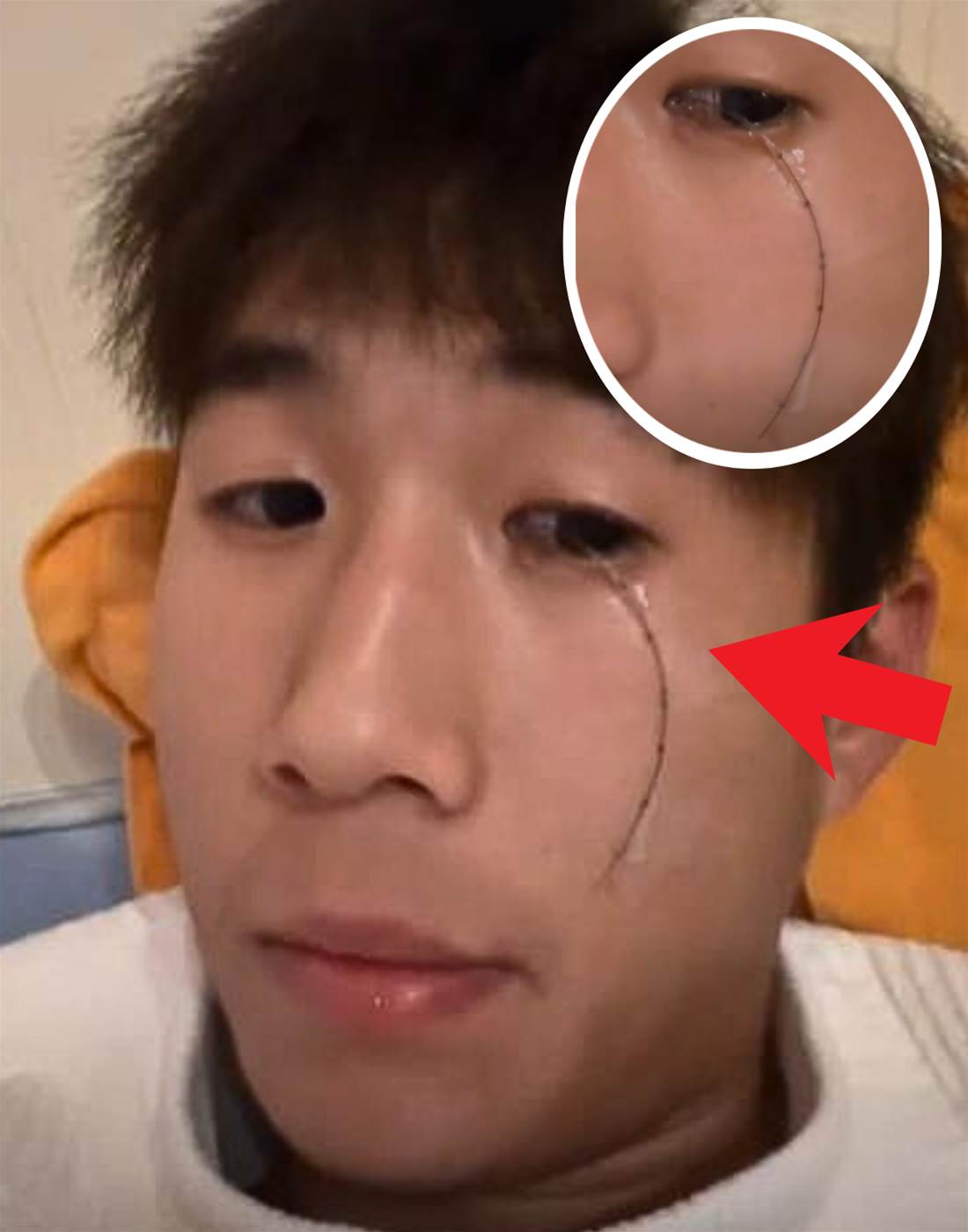 男子失戀後竟從眼中哭出「黑線」！醫生緊急手術：再晚就來不及了！