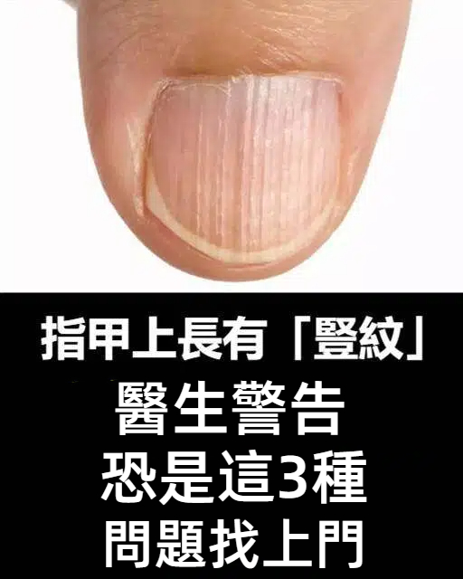 指甲冒出「豎紋」別輕忽！醫生警告：恐是這3種問題找上門